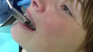 Orthodontic finishing bends