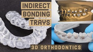 Indirect Bonding Trays – 3D ORTHODONTICS