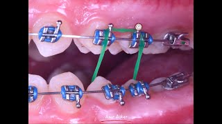 Scissor bite correction in orthodontics by cross elastic band