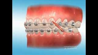 Advanced Orthodontics – Elastics