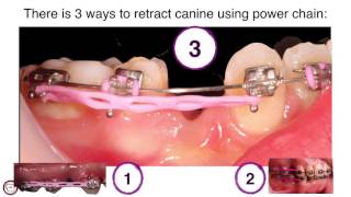 canine traction by power chain in orthodontics by dr. Amr Asker