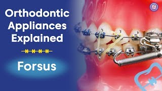 Orthodontic Appliances Explained | Forsus