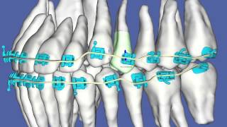 Straight Talk on Orthodontics