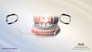 Orthodontic Expander or Spacer – E Arch Appliance