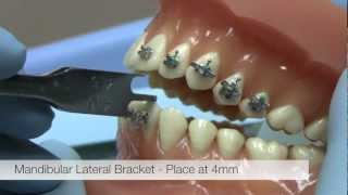 American Orthodontics Alexander LTS Brackets — Bracket Placement Video