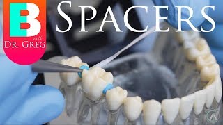 [BRACES EXPLAINED] Spacers