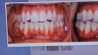 Gum Recession & Orthodontics: They're Connected!