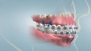 Temporary Anchorage Devices TADs   Orthodontic miniscrews