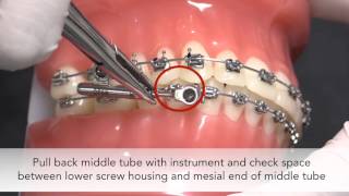 American Orthodontics PowerScope 2 Class II Corrector Activation Process