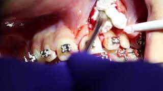 Orthodontic closed traction of impacted canine