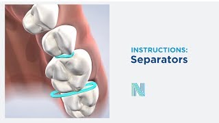 Separator Instructions in Fresno CA | Nalchajian Orthodontics