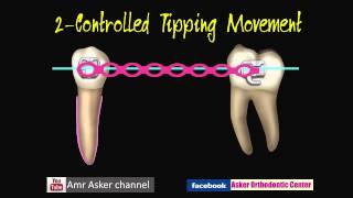 Types of Orthodontic Tooth movement