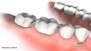 Orthodontic Separator or Spacer – Metal Helix