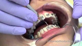 Getting Braces On at Orleans Orthodontics –  Cool French Video!!!