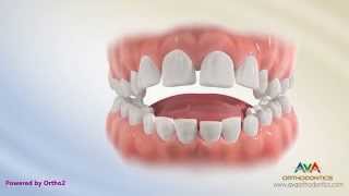 Orthodontic Treatment for Tongue Thrusting Habit – Different Options