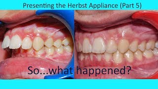 Presenting the Herbst appliance (Part 5) | Tom Nasiopoulos Orthodontist