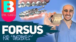 Braces Forsus for Overbite (Overjet) Correction