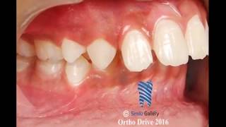 Braces (Orthodontic Treatment) Journey Before & After Transformation Second video Results