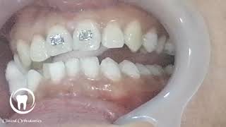 Follow new case from zero point orthodontic TTT