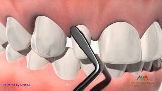 Orthodontic & Restorative Treatment for Small or Peg Lateral Incisor – Composite Build Up