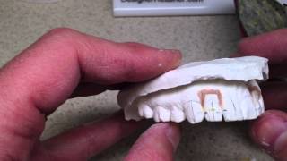 Clear Aligner – Invisible Orthodontic Retainer to Move Teeth