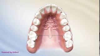 Moin Orthodontics – Palatal Bar