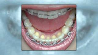 Dental Patient Education  Orthodontics