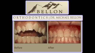 Orthodontist Littleton – Bellon Orthodontics – The Preferred Orthodontics Littleton