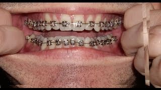 Braces – Photo taken every day – Before and After Transformation – Orthodontics Timelapse