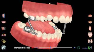 Orthodontics with a Herbst Appliance
