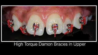 Orthodontic case presentation of Class II division 1, Damon–ortho education +extraction-deep bite