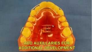 EXPANSION APPLIANCE LABS | REMOVABLE ORTHODONTIC EXPANSION APPLIANCES