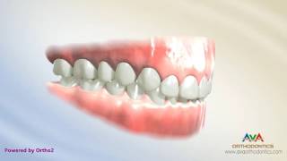 Orthodontic Treatment for Deepbite – Cantilever Wire