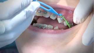 How to Wear Orthodontic Elastic Bands