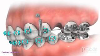 Orthodontic Mini-Implant (TAD or TSA)