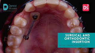 Surgical & orthodontic insertion of the canine into the arch