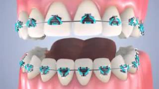 Complete Orthodontic Treatment