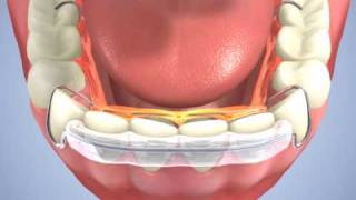 Hawley Spring Aligner- Naidu Orthodontics