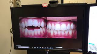 Weber Orthodontics | Best Invisalign Orthodontist | Omaha & Elkhorn, NE