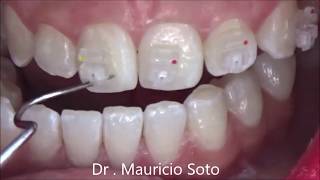 Orthodontic Brackets Bonding step by step