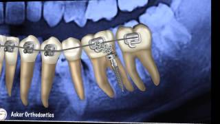 Orthodontic Case presentation-braces-brackets-impacted teeth-uprighting