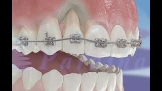 Orthodontic extrusion ©