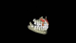 Impacted canine tooth surgery – Wheaton orthodontist