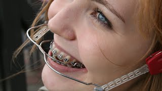 Laura Orthodontic Braces with High Pull Headgear and Milwaukee Brace!