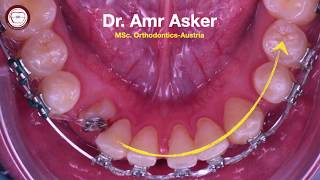 Step by step orthodontic archwire insertion for rotated canine traction by Dr. Amr Asker