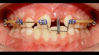 Orthodontic Treatment of an Impacted Dilacerated Upper Central Incisor – Alaa