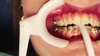 A Braces Time Lapse at Mack & Hansen Orthodontics serving Longview, Kilgore, Gilmer, and Marshall TX