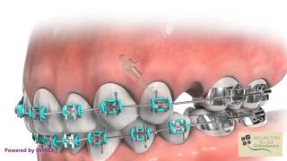 TAD for Mesializing Molars – Wellington Village Orthodontics