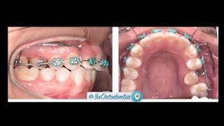 How make a sliding jig – orthodontics