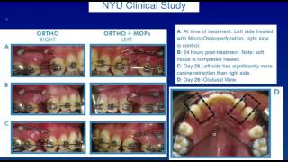Dental Treatment: Accelerated Orthodontics Jul 17, 2017
